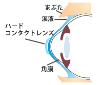 ハードコンタクトレンズ