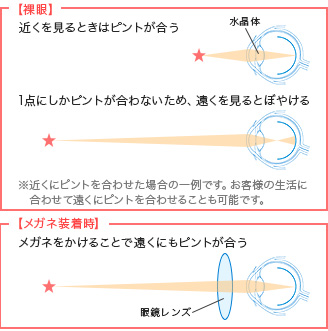 白内障レンズの特徴